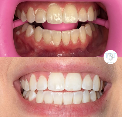 Whitening by TNT Before and After