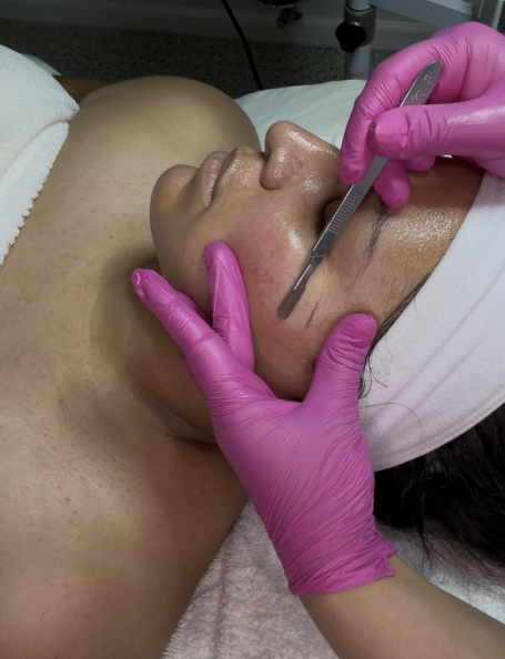 Dermaplaning